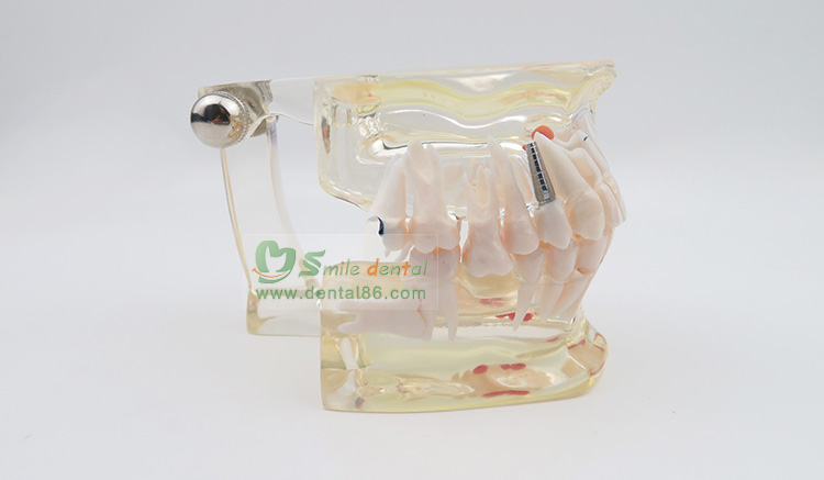 TM-C2 Pathology Model with a tooth missing